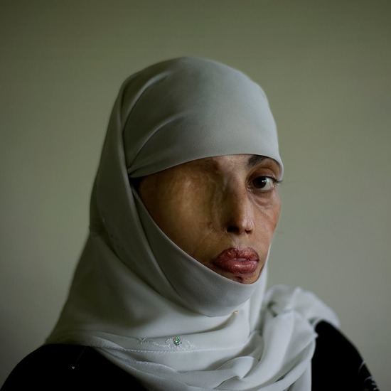 Второ лице: Съдбата на жените, пострадали от киселинна атака